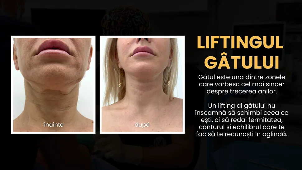 Liftingul de gât: de ce gâtul îmbătrânește primul și când devine operația estetică o opțiune (P)