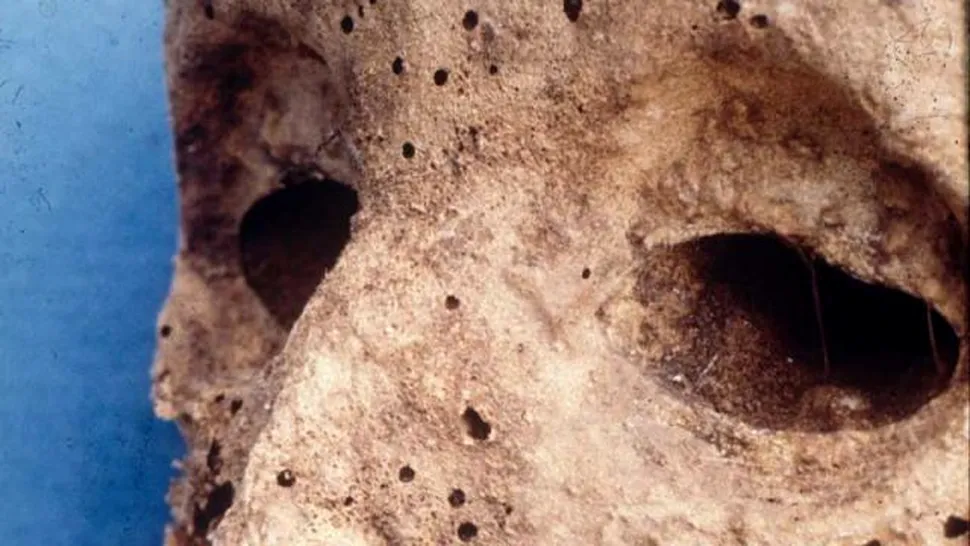 Analiza ADN a unei mumii vechi, despre care se credea că a avut variolă, a indicat prezenţa hepatitei B