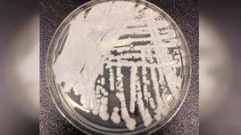 Ciuperca Candida auris este acum endemică în cinci state din Europa, inclusiv România. Poate fi ținută sub control?