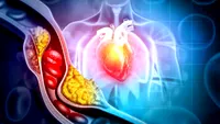 Poți face infarct chiar dacă ai colesterolul normal? Ce spun medicii despre riscul pe care analizele nu îl arată