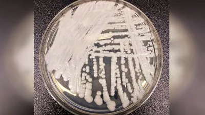 Ciuperca Candida auris este acum endemică în cinci state din Europa, inclusiv România. Poate fi ținută sub control?