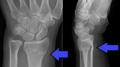 FDA a aprobat un sistem bazat pe inteligenţă artificială care detectează fracturile la încheieturile mâinilor