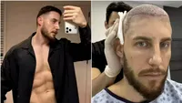 A vrut un transplant de păr ieftin în Turcia, dar a plătit scump greșeala. Ce a descoperit după 8 ani