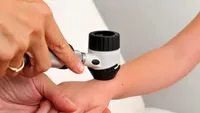 Primul semn al cancerului de piele! La ce să fii atent, ca să-ți crești șansele de vindecare
