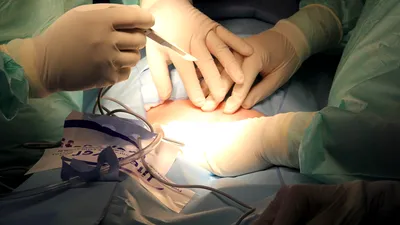 Descoperire tulburătoare făcută în abdomenul unei femei la nouă luni după o operație