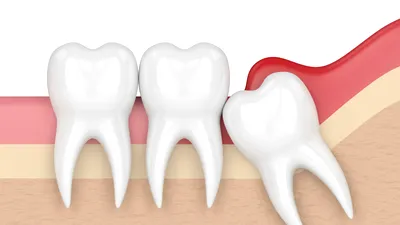Implanturile dentare, reduse la o simplă injecție pentru stimularea regenerării dentiției naturale