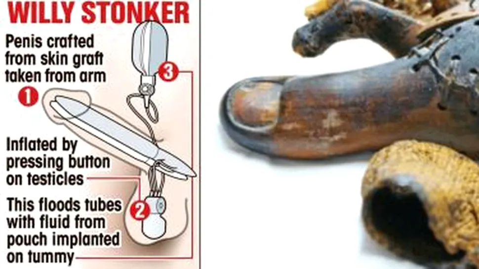 Scurtă istorie a protezelor: Drumul lung de la cârligul lui Captain Hook la penisul bionic