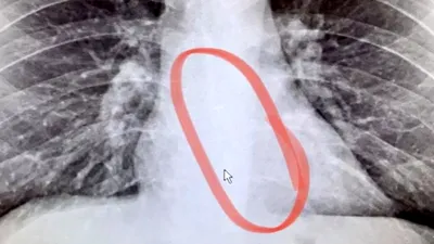 Descoperire tulburătoare făcută în radiografia pieptului unui bărbat care suferea de un „gât uscat”