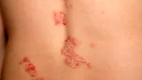Remedii naturale care pot ajuta în psoriazis. Ce metode au fost studiate și ce trebuie evitat?