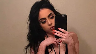 O tânără care suferă de vitiligo a găsit puterea să îşi arate corpul pe Instagram
