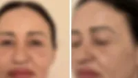 Cum se apără medicul estetician în cazul femeii aflată în moarte cerebrală, după un lifting facial! Imagini șocante cu Valentina