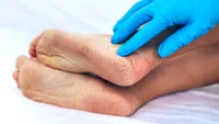 Semn neobișnuit la nivelul picioarelor care ar putea indica probleme hepatice. Medic: „Ficatul transmite semnale prin piele”