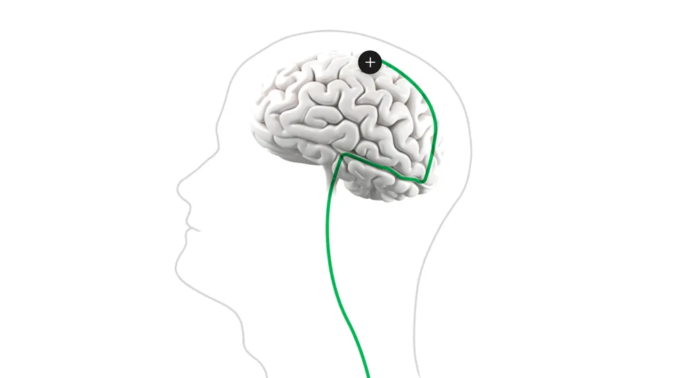 Synchron și OpenAI revoluționează comunicarea pentru persoanele cu tulburări neurologice