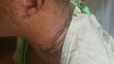 A suferit arsuri grave pe gât şi mâini după ce a luat cu el în pat iPhone-ul conectat la priză