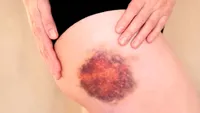 De ce apar vânătăi fără să te lovești? Când sunt normale și când pot ascunde o problemă de sănătate
