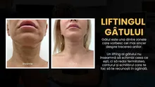 Liftingul de gât: de ce gâtul îmbătrânește primul și când devine operația estetică o opțiune (P)