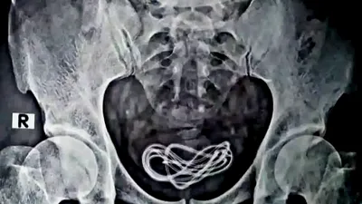 Descoperire bizară în corpul unui bărbat: un cablu de telefon